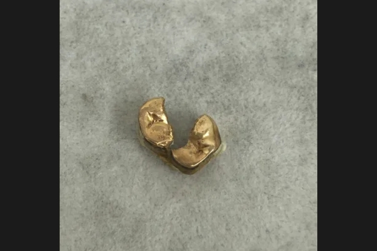 金歯 2.5g